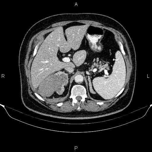 Adrenal hemorrhage (Radiopaedia 62622-70916 Axial C+ portal venous phase 48).jpg