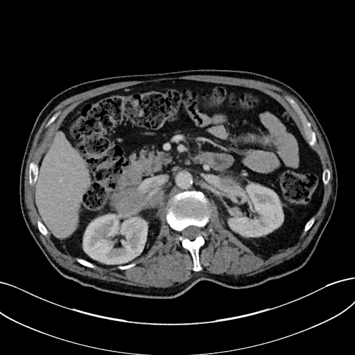 File:Adrenal lymphoma (Radiopaedia 73730-84529 Axial C+ portal venous phase 44).jpg