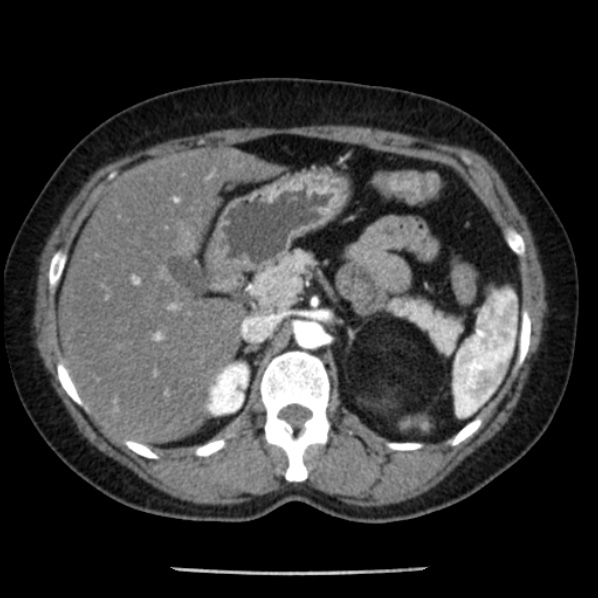 Adrenal myelolipoma (Radiopaedia 43401-46759 Axial C+ arterial phase 32).jpg