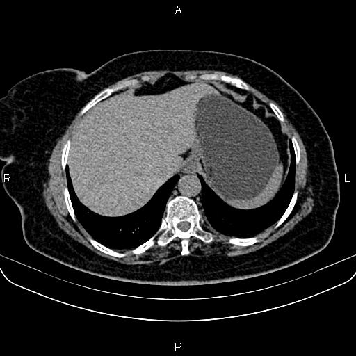 Adrenal myelolipoma (Radiopaedia 82742-96986 Axial non-contrast 18).jpg