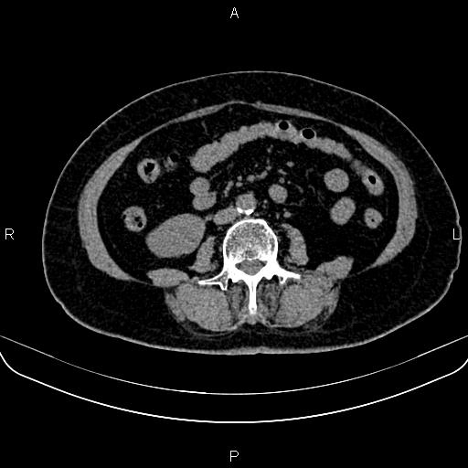 Adrenal myelolipoma (Radiopaedia 82742-96986 Axial non-contrast 89).jpg