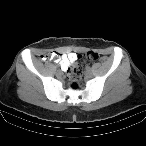 Adrenal myelolipoma - bilateral (Radiopaedia 74805-85810 Axial non-contrast 64).jpg