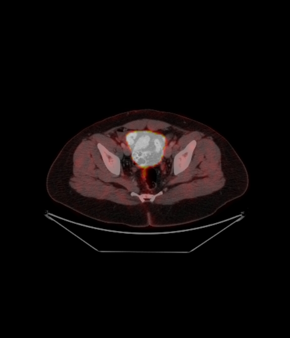 Adrenocortical carcinoma (Radiopaedia 80134-93440 ِAxial 238).jpg