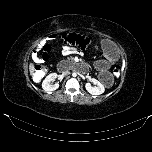 File:Afferent loop syndrome - secondary to incarcerated trocar site hernia (Radiopaedia 82959-97305 Axial C+ portal venous phase 100).jpg