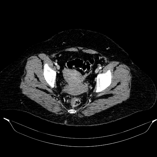 File:Afferent loop syndrome - secondary to incarcerated trocar site hernia (Radiopaedia 82959-97305 Axial C+ portal venous phase 212).jpg