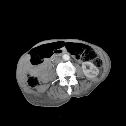 File:Aggressive lung cancer with cardiac metastases, pulmonary artery tumor thrombus, and Budd-Chiari (Radiopaedia 60320-67981 A 75).jpg