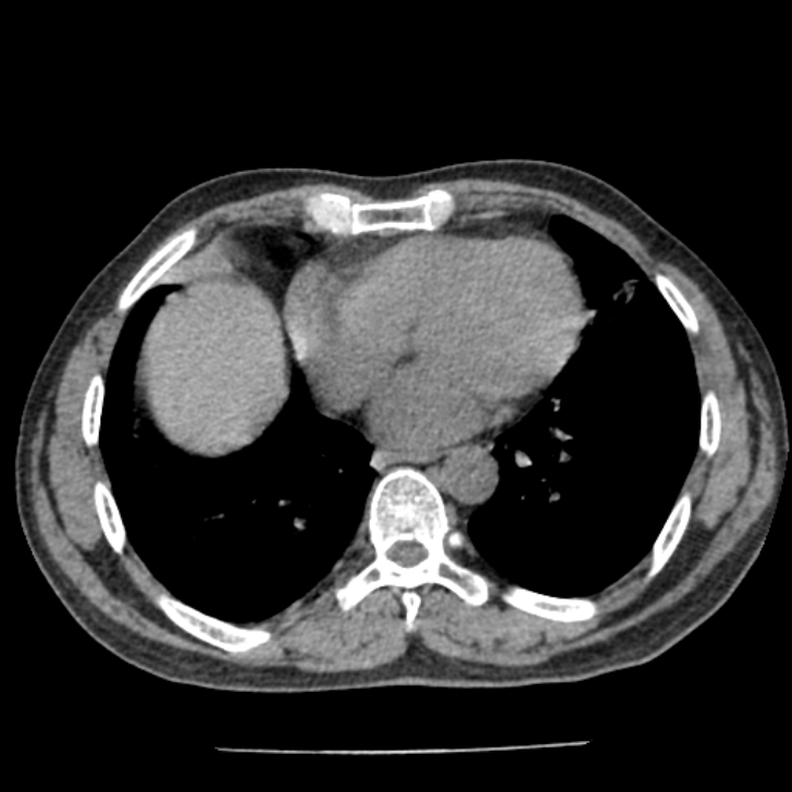 Airway foreign body in adult (Radiopaedia 85907-101779 Axial liver window 126).jpg