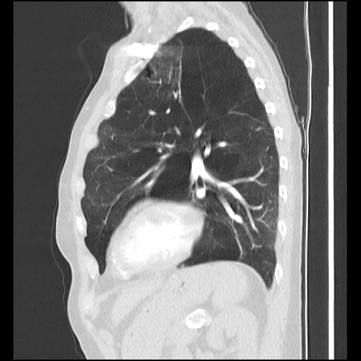 Alpha-1-antitrypsin deficiency (Radiopaedia 64893-73840 Sagittal lung window 39).jpg
