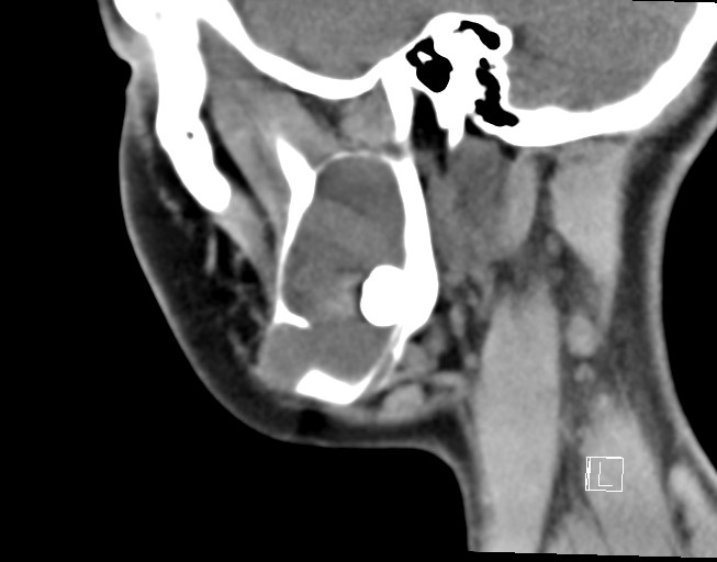 File:Ameloblastoma (Radiopaedia 26645-26793 Sagittal C+ delayed 6).jpg