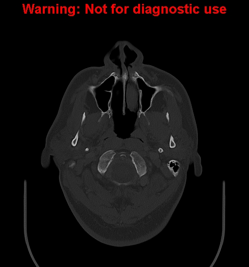 Ameloblastoma (Radiopaedia 33126-34164 Axial bone window 1).jpg