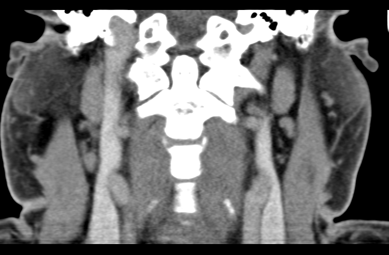 Ameloblastoma (Radiopaedia 33677-34806 Coronal non-contrast 46).png