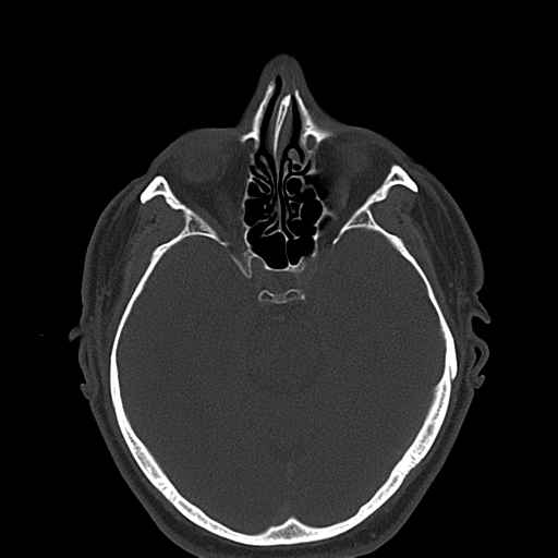Ameloblastoma (Radiopaedia 38520-40623 Axial bone window 6).png