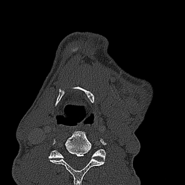 Ameloblastoma (Radiopaedia 51921-57766 Axial bone window 15).jpg