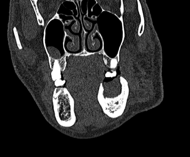 Ameloblastoma (Radiopaedia 51921-57766 Coronal bone window 76).jpg