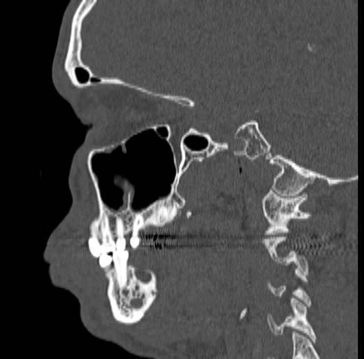 Ameloblastoma (Radiopaedia 77750-89997 Sagittal bone window 26).jpg