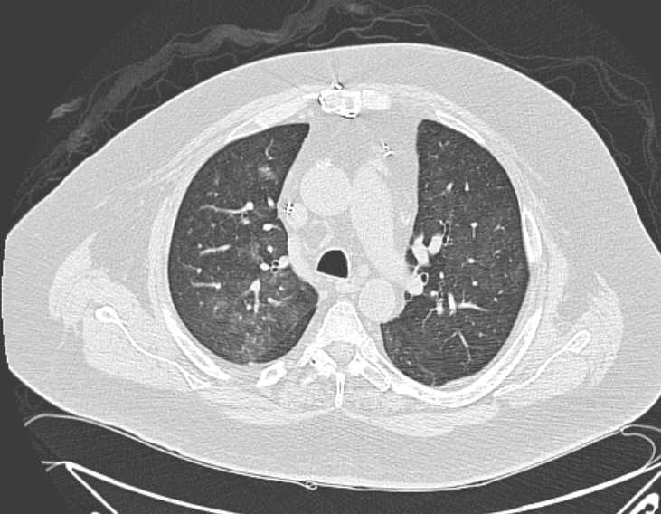 Amiodarone lung (Radiopaedia 62514-70769 Axial lung window 32).jpg