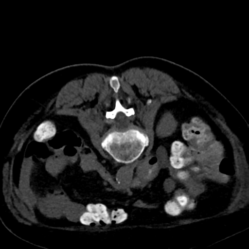 Ampullary adenocarcinoma (Radiopaedia 34013-35241 C 57).png