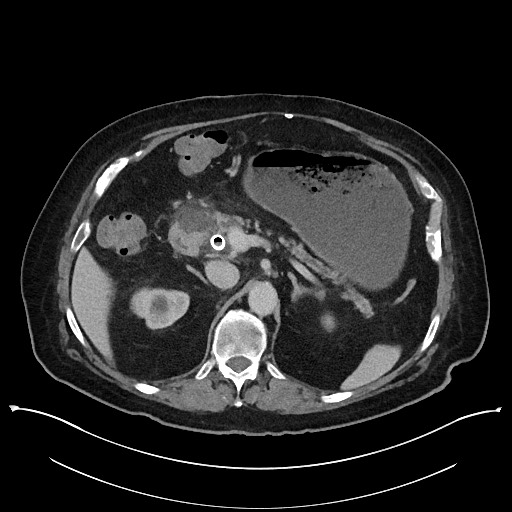 Ampullary adenocarcinoma (Radiopaedia 59373-66737 A 56).jpg
