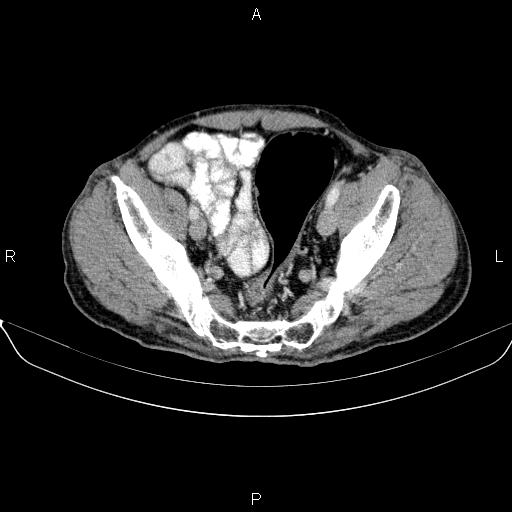 Ampullary adenocarcinoma (Radiopaedia 86093-102032 A 48).jpg