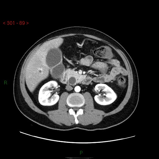 Ampullary carcinoma (Radiopaedia 56396-63056 B 35).jpg
