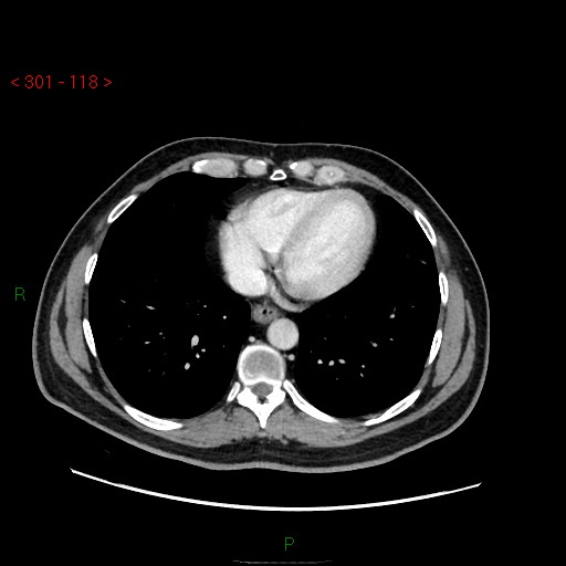 File:Ampullary carcinoma (Radiopaedia 56396-63056 C 6).jpg