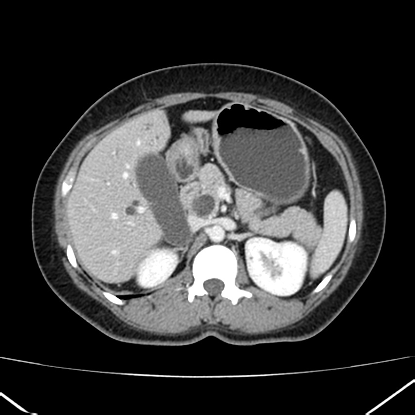 Ampullary tumor (Radiopaedia 22787-22816 C 22).jpg