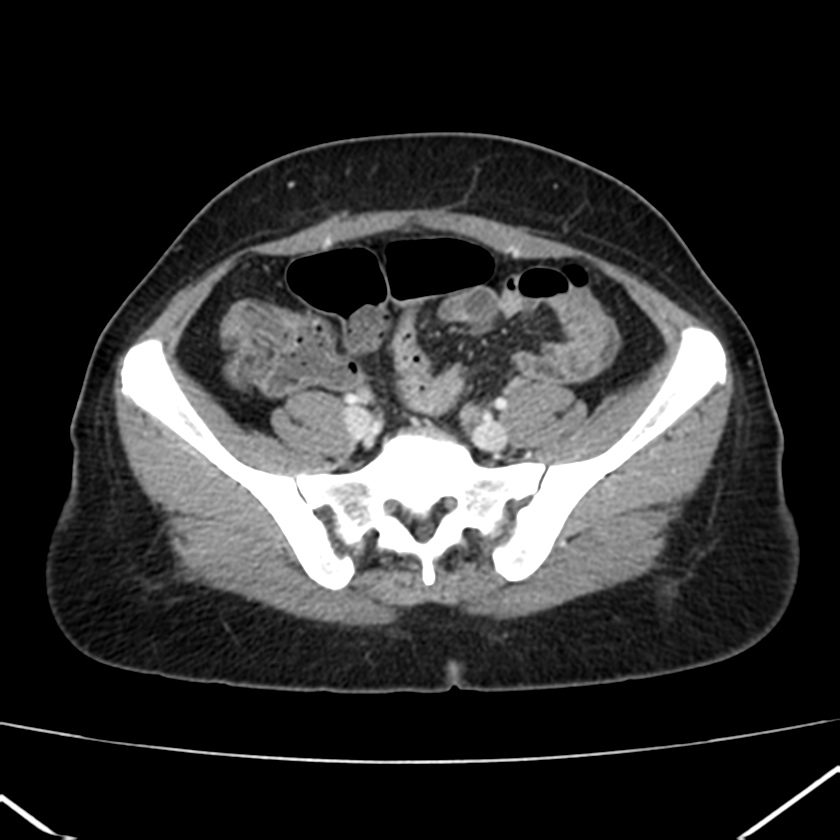 Ampullary tumor (Radiopaedia 22787-22816 C 51).jpg
