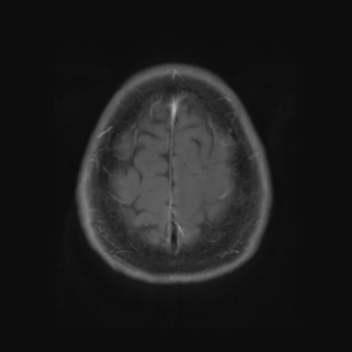File:Amyloid angiopathy with inflammation (Radiopaedia 30360-31002 Axial T1 C+ fat sat 29).jpg