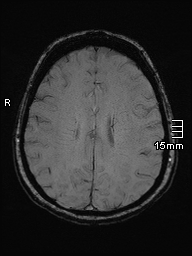 Amyotrophic lateral sclerosis (Radiopaedia 70821-81017 Axial SWI 36).jpg