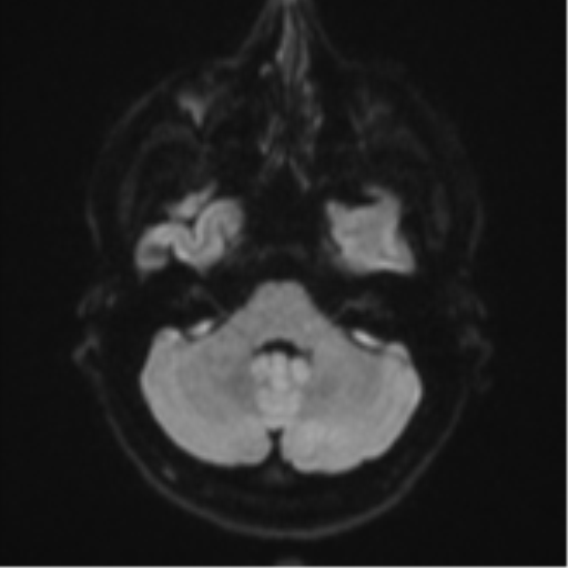 File:Anaplastic astrocytoma (Radiopaedia 57768-64731 Axial DWI 34).png