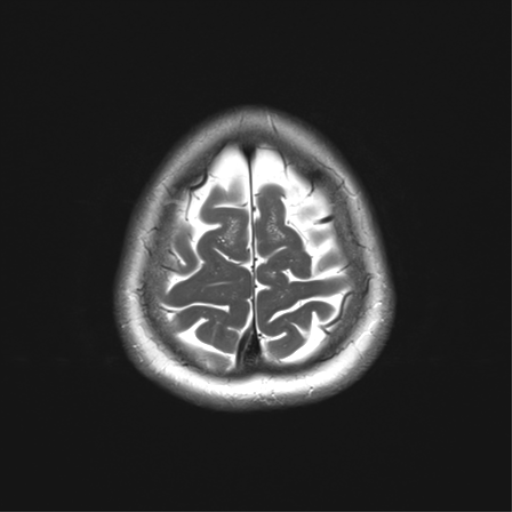 File:Anaplastic astrocytoma (Radiopaedia 86943-103160 Axial T2 34).png