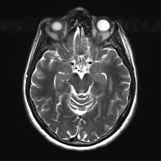 File:Anaplastic astrocytoma - thalamic glioma (Radiopaedia 59709-67115 Axial T2 15).png