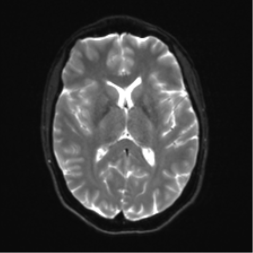 Anaplastic astrocytoma IDH mutant (Radiopaedia 50046-55341 Axial DWI 15).png