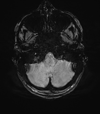 File:Anaplastic astrocytoma IDH mutant (Radiopaedia 50046-55341 Axial SWI 16).png