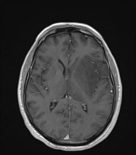 Anaplastic astrocytoma IDH wild-type (Radiopaedia 49984-55273 Axial T1 C+ 31).png