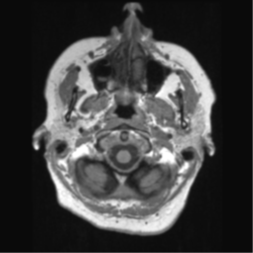 Anaplastic astrocytoma IDH wild-type (pseudoprogression) (Radiopaedia 42209-45276 Axial T1 17).png