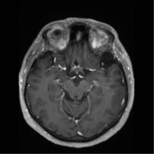 File:Anaplastic astrocytoma IDH wild-type (pseudoprogression) (Radiopaedia 42209-45276 Axial T1 C+ 63).png