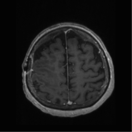 File:Anaplastic astrocytoma IDH wild-type (pseudoprogression) (Radiopaedia 42209-45277 Axial T1 C+ 99).png