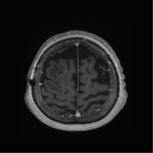 File:Anaplastic astrocytoma IDH wild-type (pseudoprogression) (Radiopaedia 42209-45278 Axial T1 C+ 128).png