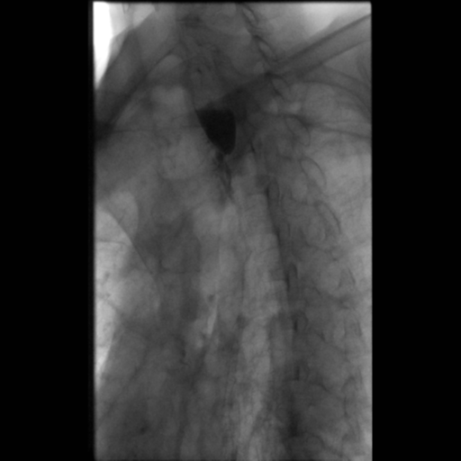 File:Anastomotic stricture post Ivor Lewis esophagectomy (Radiopaedia 47937-52715 Oblique 9).png