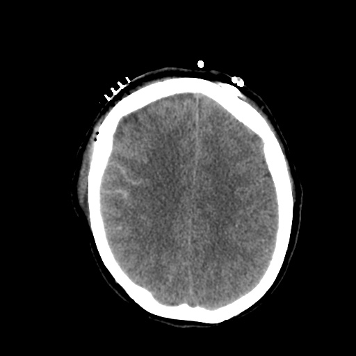 Aneursym related subarachnoid hemorrhage with hydrocephalus (Radiopaedia 45105-49085 Axial non-contrast 36).jpg