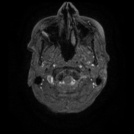 Aneurysm of the terminal internal carotid artery (Radiopaedia 88167-104764 H 3).jpg