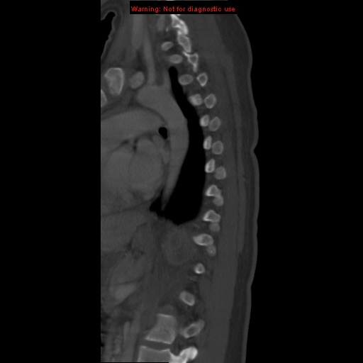 File:Aneurysmal bone cyst (Radiopaedia 9419-10102 Sagittal bone window 15).jpg