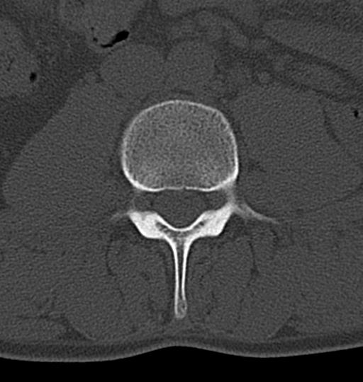 Aneurysmal bone cyst T11 (Radiopaedia 29294-29721 Axial bone window 90).jpg
