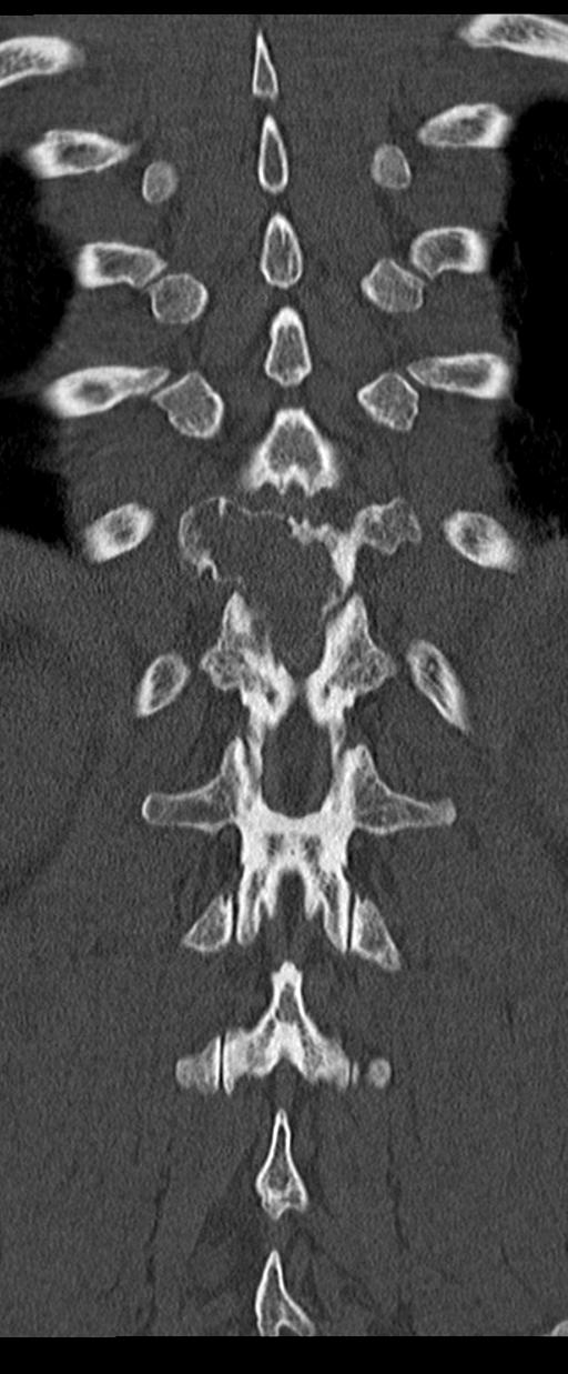Aneurysmal bone cyst T11 (Radiopaedia 29294-29721 Coronal bone window 48).jpg
