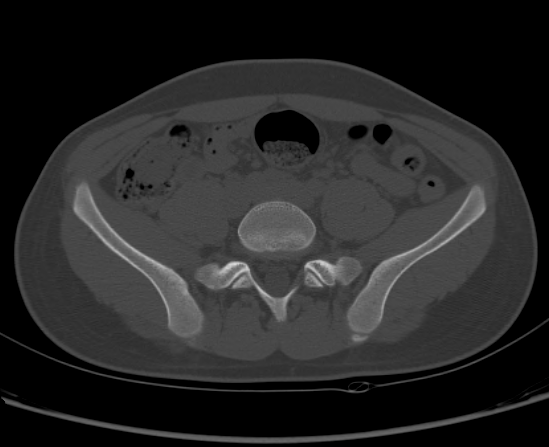File:Aneurysmal bone cyst of ischium (Radiopaedia 25957-26094 Axial bone window 16).png