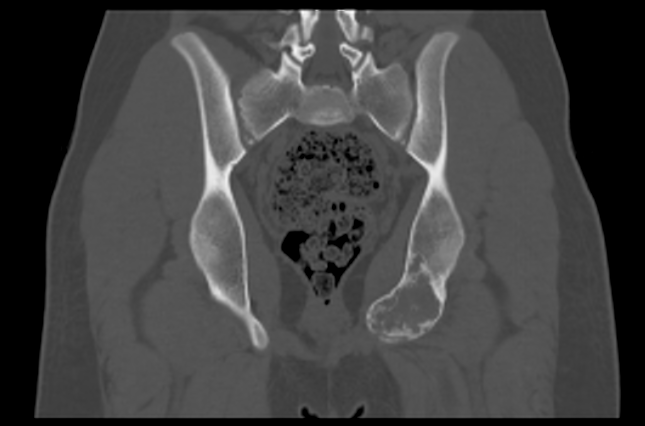 File:Aneurysmal bone cyst of ischium (Radiopaedia 25957-26094 Coronal bone window 28).png