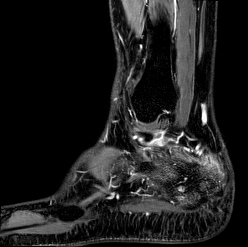 File:Aneurysmal bone cyst of the calcaneus (Radiopaedia 60669-68420 F 3).jpg
