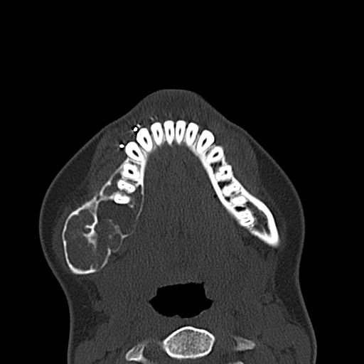 Aneurysmal bone cyst of the mandible (Radiopaedia 43280-46601 Axial bone window 22).jpg