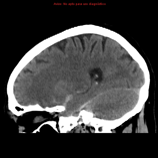 File:Aneurysmal subarachnoid hemorrhage (Radiopaedia 24740-24997 non-contrast 18).jpg